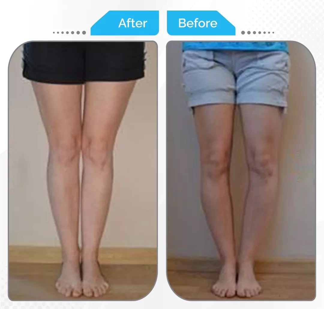 Surgical correction of bow leg (genu varum) alignment by Dr. Fawzy Issa