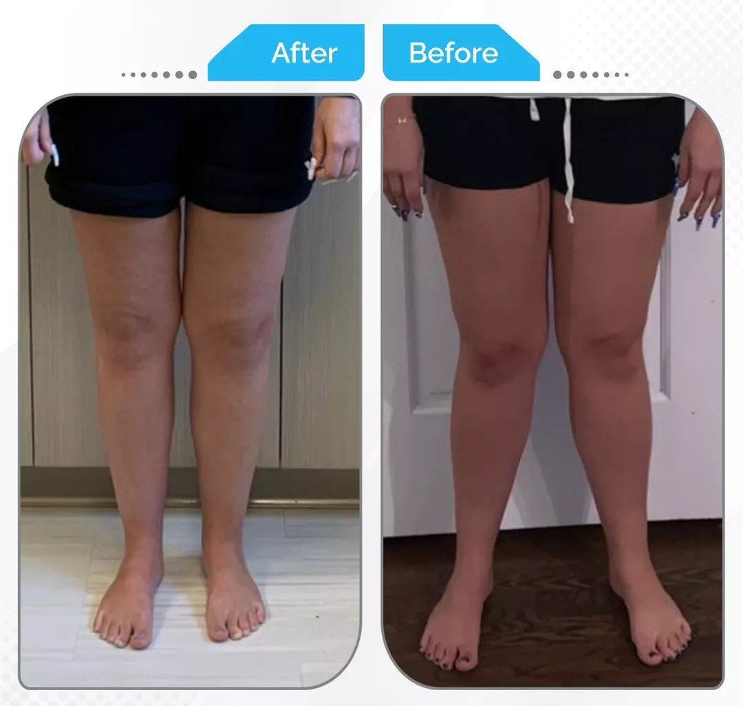 Surgical correction of knock knee (genu valgum) alignment by Dr. Fawzy Issa