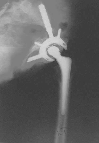 Revision joint replacement surgery Dr. Fawzy Issa in Kuwait